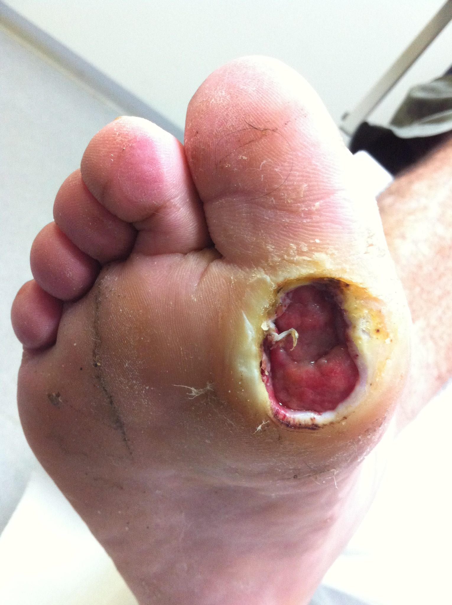 # Diabetic Foot Ulcer Pictures - Diabetes Causes Kidney ...