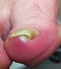 An ingrown toenail developing an infection about to be treated by our Brisbane podiatrists