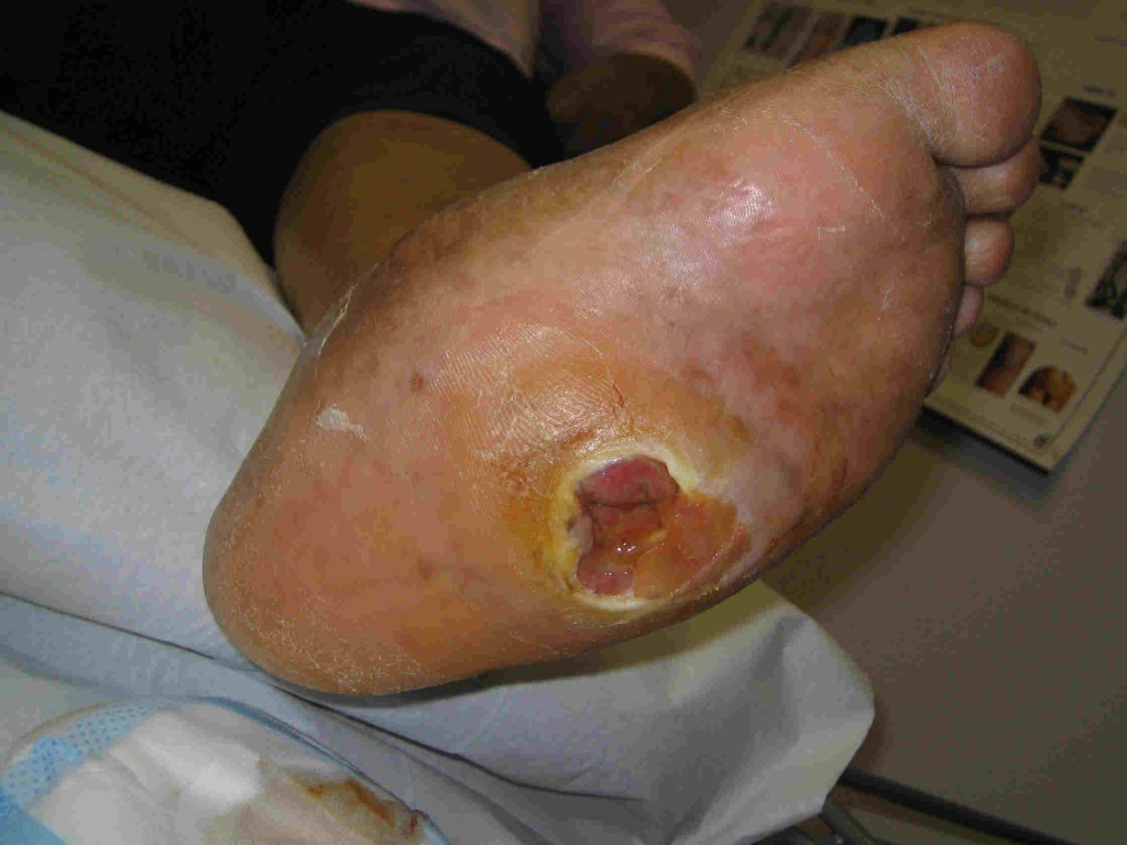Charcot midfoot deformity before treatment by Brisbane podiatrist
