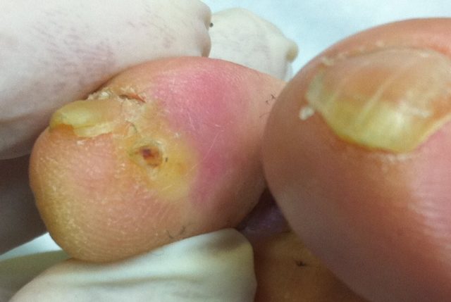 Corn before treatment by Brisbane podiatrists