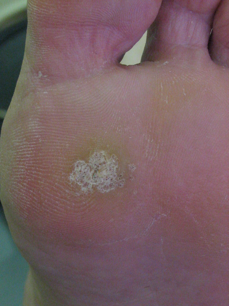 plantar wart Podiatrist Brisbane Southside The Podiatry Practice Orthotics, Ingrown Toenails