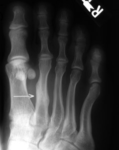 A severe stress fracture that has gone untreated and progressed to a full fracture.