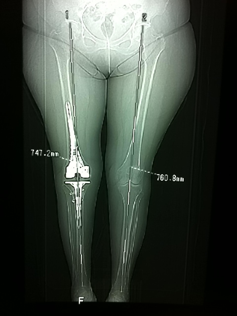 CT scanogram for leg length difference
