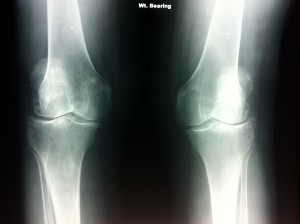 Podiatry Practice treats bilateral knee osteoarthritis, knee x-ray