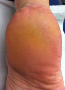 Clinical appearance of heel after one podiatry treatment.