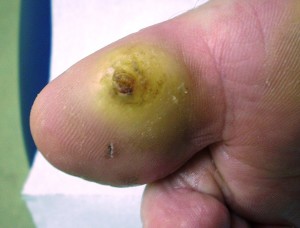 Neuropathic big toe ucler prior to sharp debridement