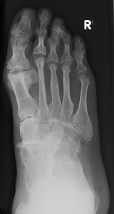 RA foot