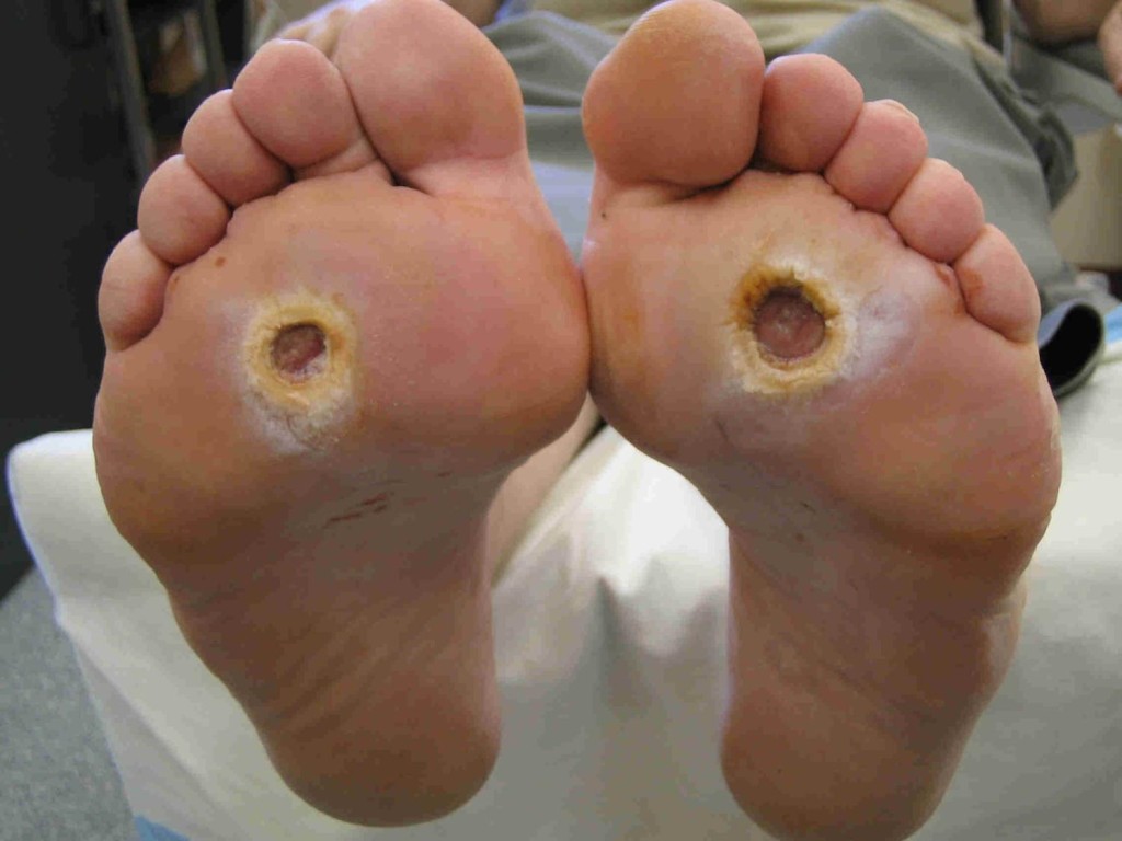 foot ulcer diabetes