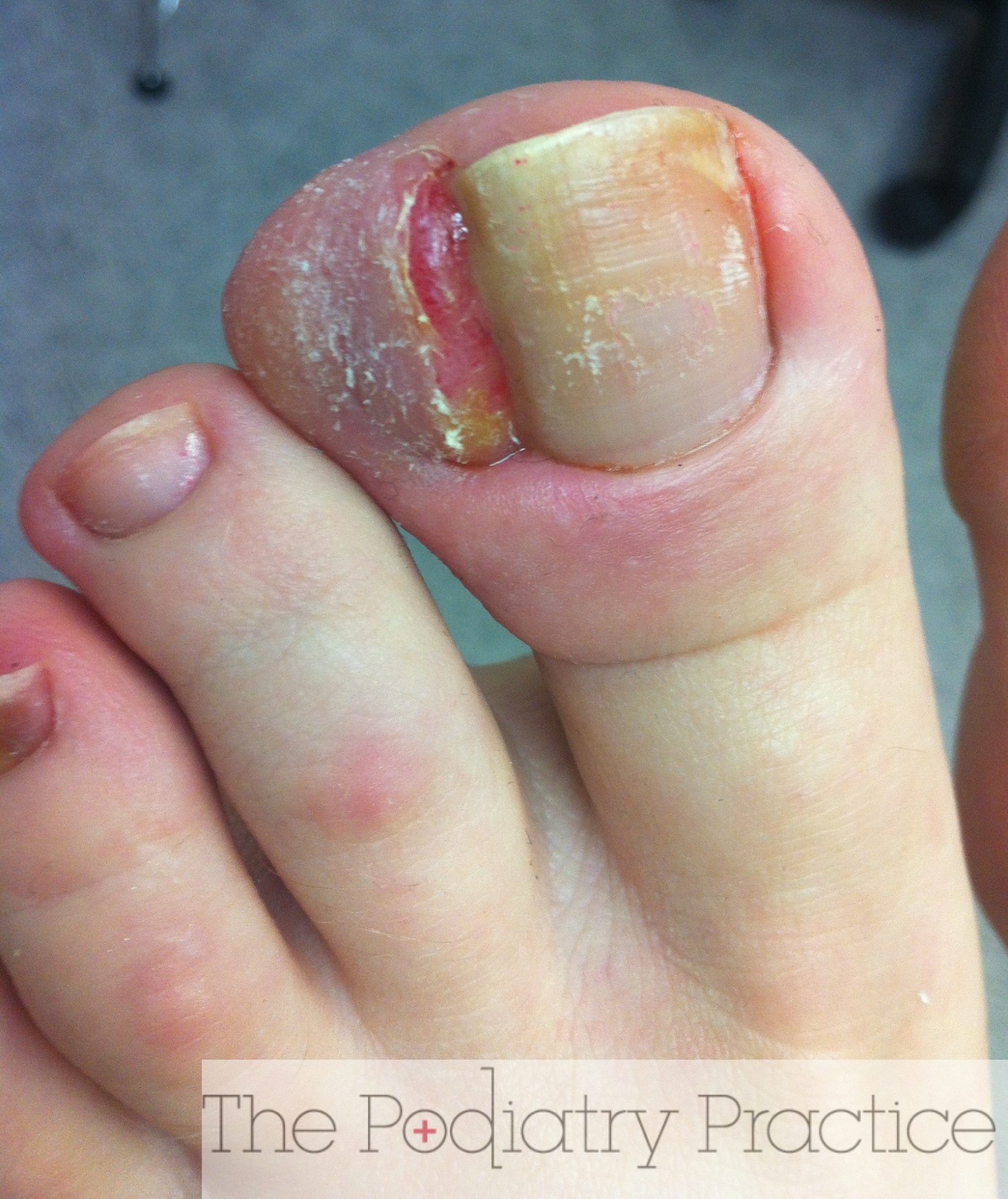 Wow, this is a severe ingrown toenail! Podiatrist Brisbane Southside