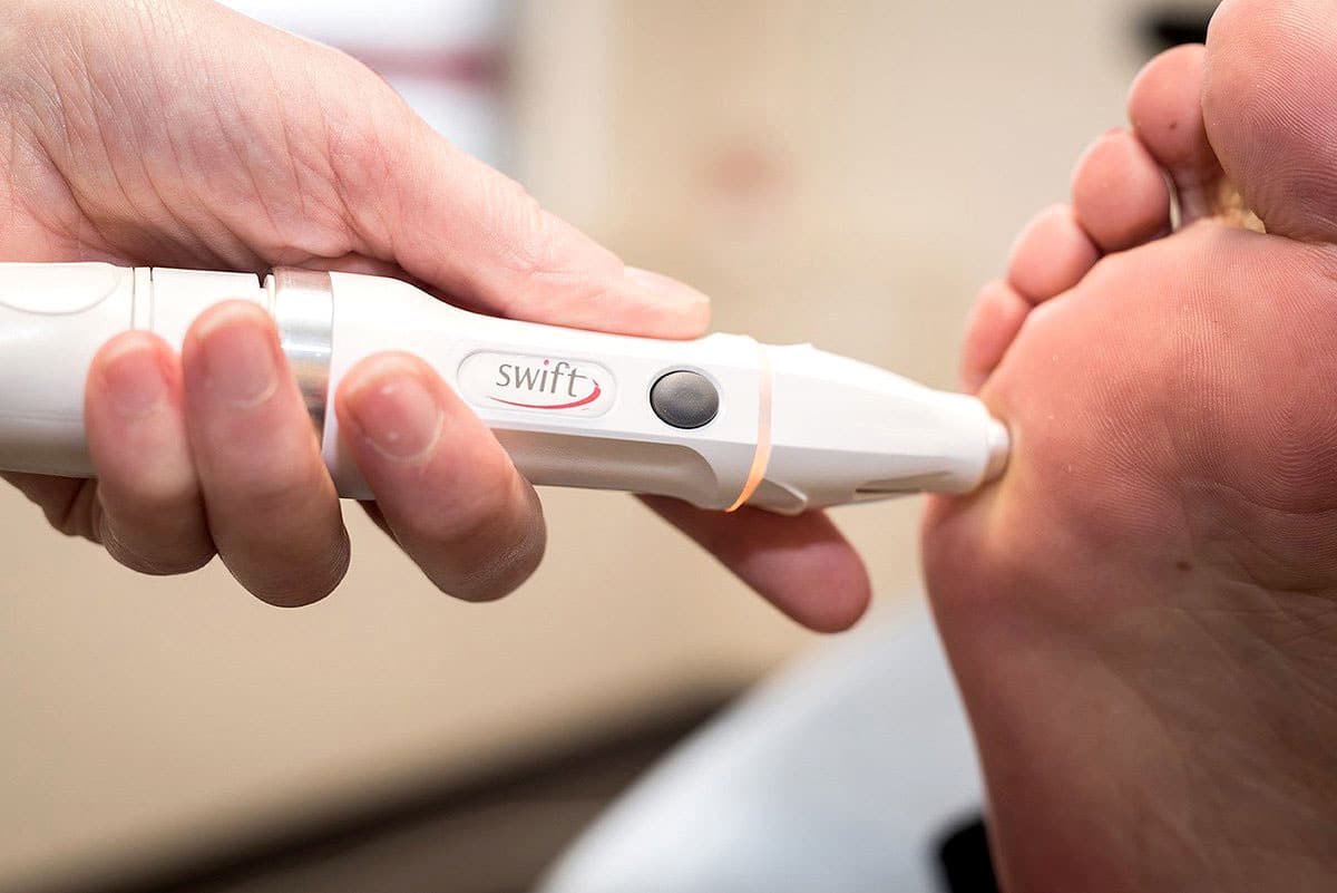 SWIFT WART TREATMENT Podiatrist Brisbane Southside The Podiatry